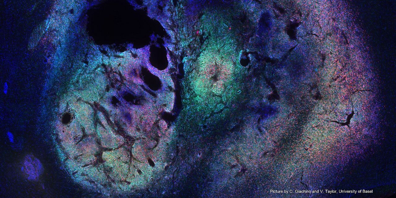Image of  amurine brain tumor